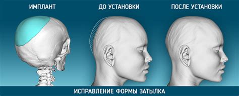 Голова ОК!: Брахицефалическая форма головы。